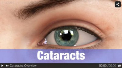 Video: Cataracts
