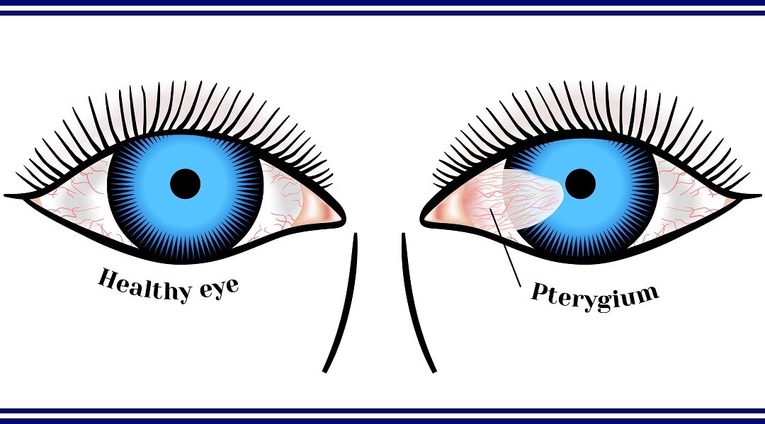 What Is a Pterygium?