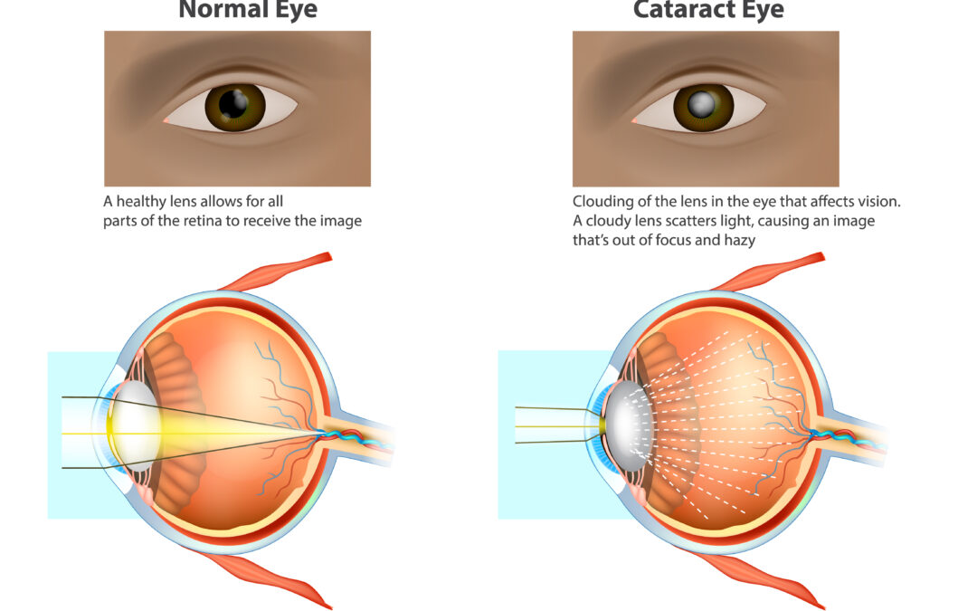 Causes of Early Onset Cataracts