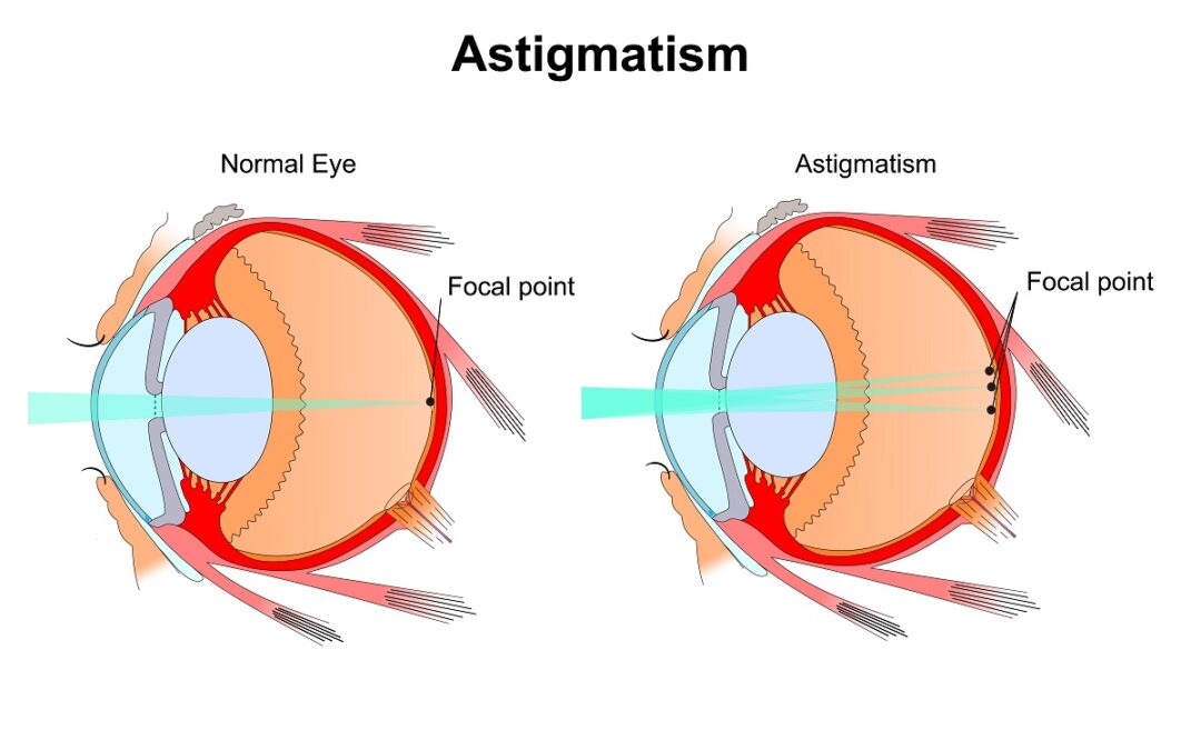 What Is Astigmatism and How Is It Treated?